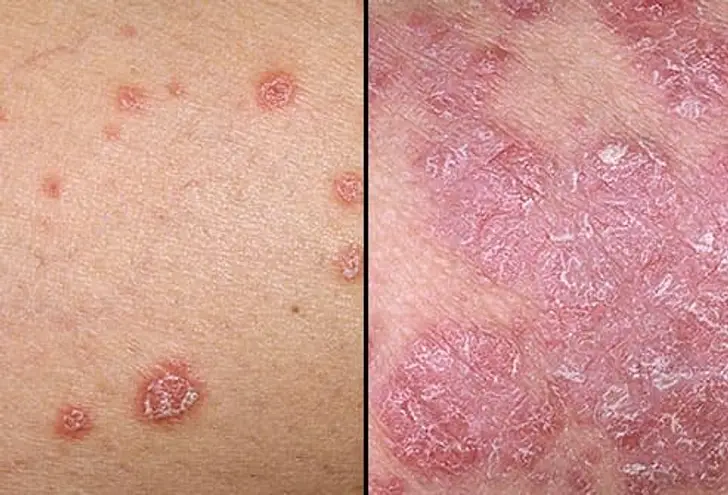 Vaidyaraj Anil says, "Psoriasis is Curable & 'Auto-immune' is a false Concept. Eczema, Acne, Rosacea & all Skin Issues have Roots in Gut-Skin-Axis"​