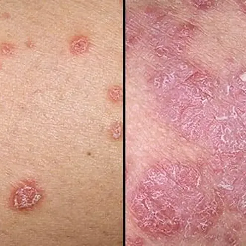 psoriasis_square